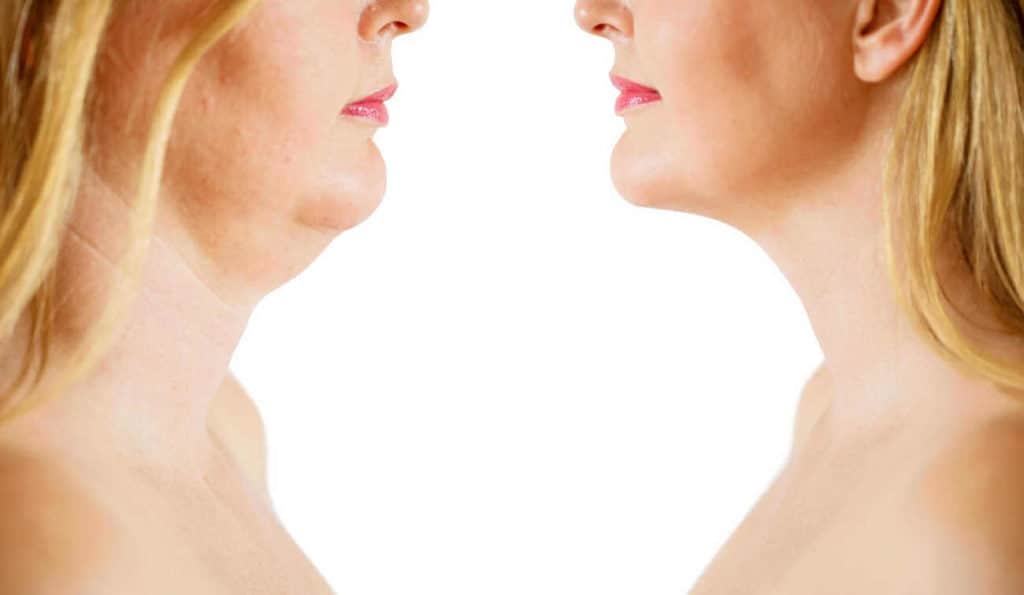 Double Chin treatment Cirencester before and after results