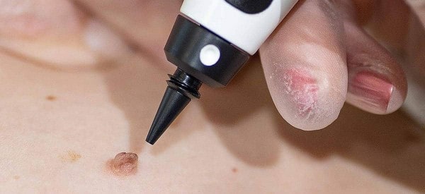 After Skin Tag Removal Cirencester
