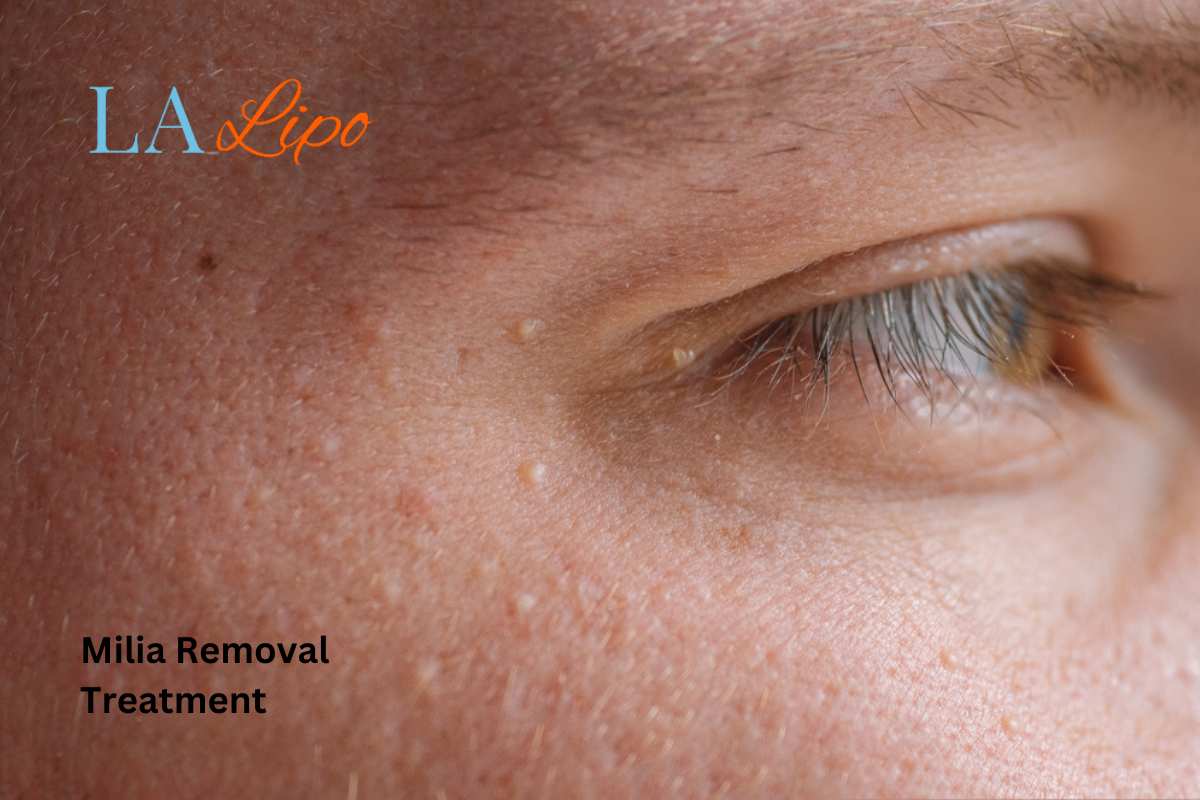 Cryopen Milia Removal: Is It the Easiest and Safest Option Cirencester?