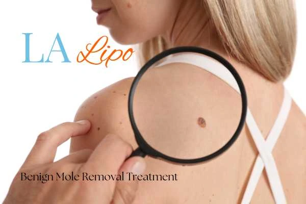 Woman having her inspection of blemish before mole removal Cirencester