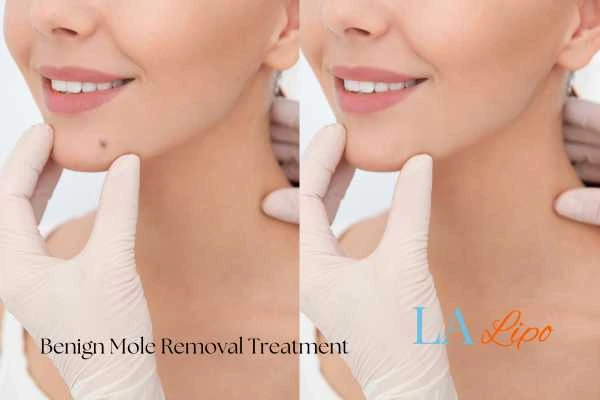 Before and after mole removal Cirencester treatment