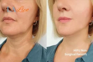hi-fu for wrinkles Cirencester before and after results