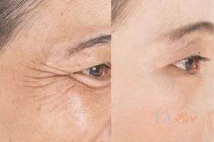 Before and after results of woman - HI-fu wrinkles reduction treatment Cirencester