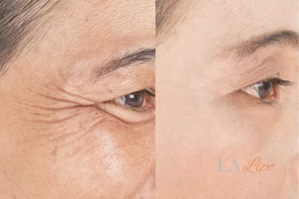 Before and after results of woman - HI-fu wrinkles reduction treatment Cirencester