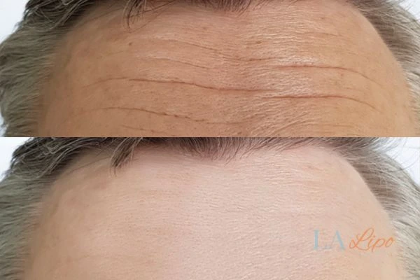results of HIFU Cirencester on mans forehead to help reduce lines and wrinkles