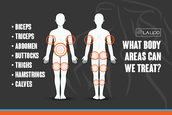 Graphic to show areas you can have LA-EMS Body Sculpting Cirencester treatment.