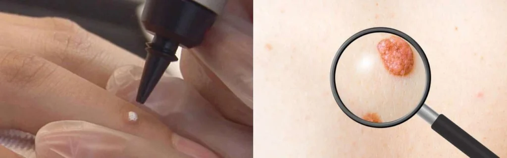 Person getting moles removed with cryopen Cirencester