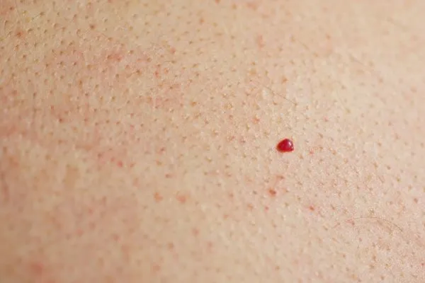 close up of a cherry angioma Cirencester