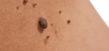 image of a skin tag Cirencester