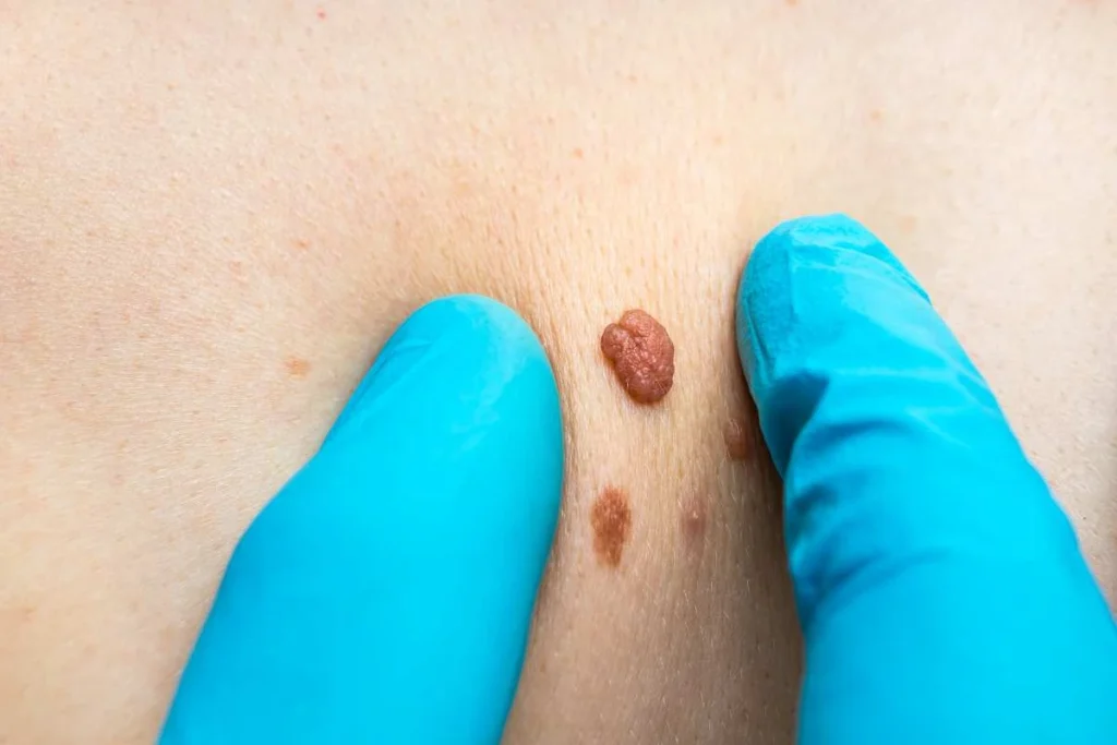 Consultant examining a skin tag Cirencester