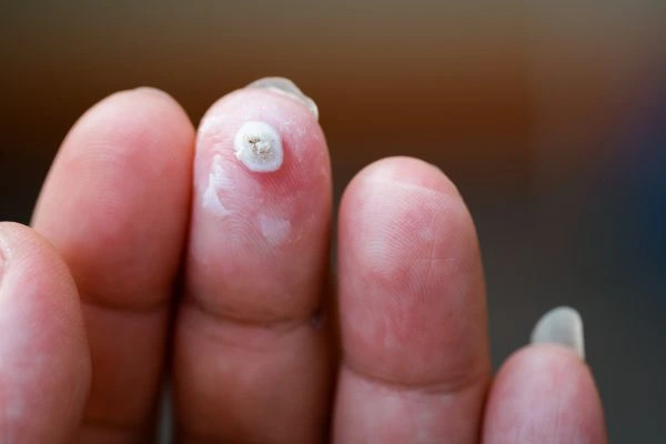 wart on person finger - cryotherapy to treat from LA LIPO Cirencester