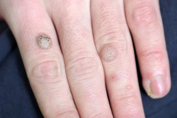 photo of warts on person hand - see wart removal Cirencester from LA LIPO