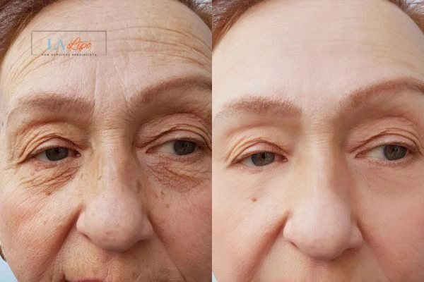 The powerful benefits of Morpheus8 Treatment Cirencester - Call Our team today!