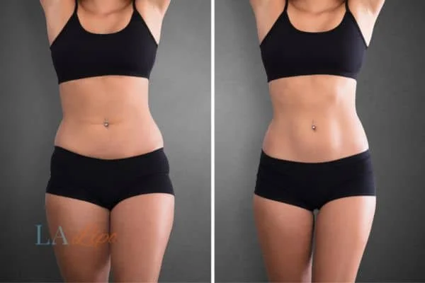before and after results of non-surgical treatment to help a woman's body image and mental health Cirencester