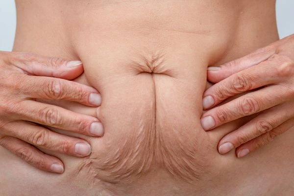 Image of a woman's stomach with loose skin - example of skin tightening Cirencester options