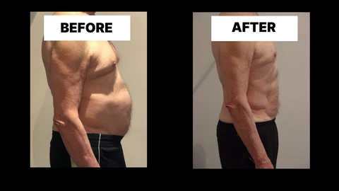 What Symptoms Can Diastasis Recti Cause in Men? Weak Core, Back Pain and Poor Posture Cirencester